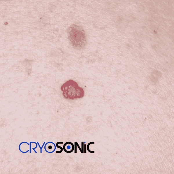 Looking for pain free cherry angioma removal treatment Weston-Super-Mare? Call our team today! Weston-Super-Mare