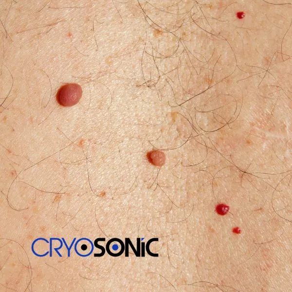 get cherry angioma removal treatment today! Weston-Super-Mare