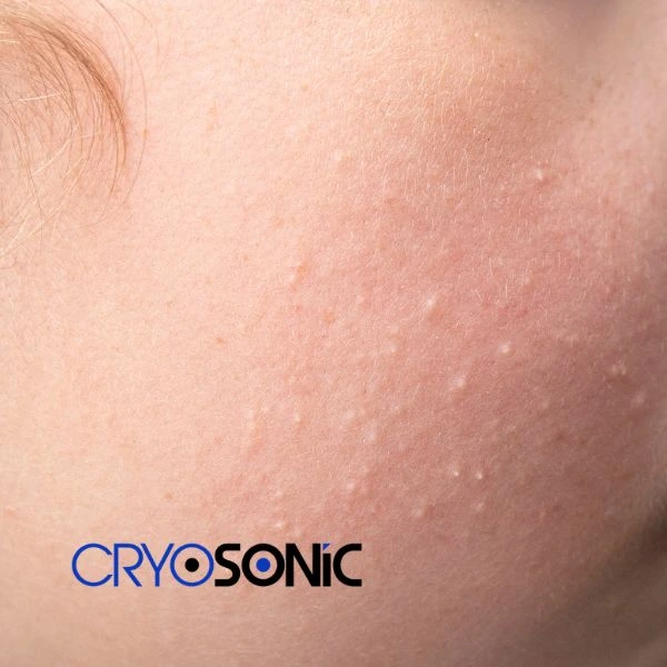 Are you looking for milia removal treatment? Contact our team today Weston-Super-Mare