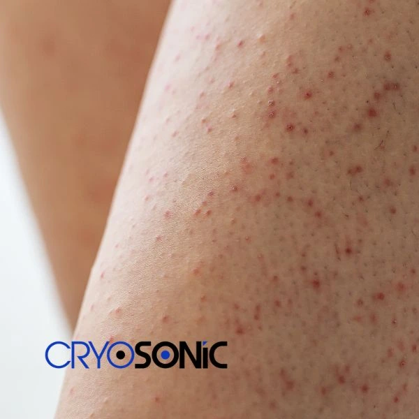 Looking for Seborrhoeic Keratosis removal Weston-Super-Mare treatment? Call our consultants today in Weston-Super-Mare