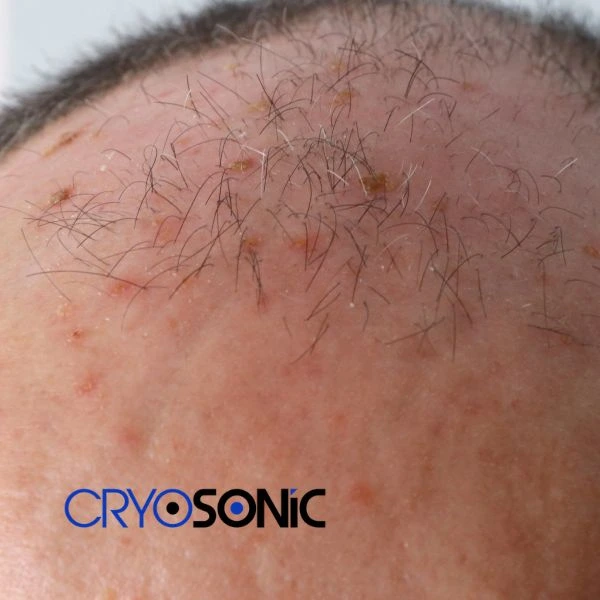 Access Seborrhoeic Keratosis removal from the comfort of your own home! Call us today in Weston-Super-Mare