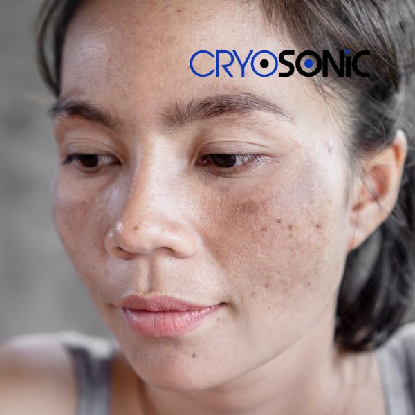 Ready to start age spots removal? Contact our team today in Weston-Super-Mare