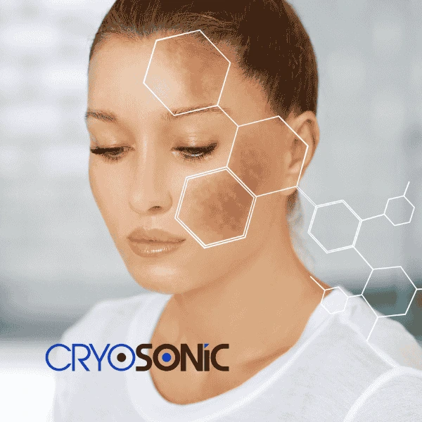 Are you looking for age spot removal treatment? Contact Cryosonic today in Weston-Super-Mare