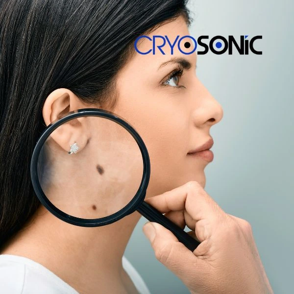 Do you want to learn more about benign moles removal treatment? Call our team today Weston-Super-Mare