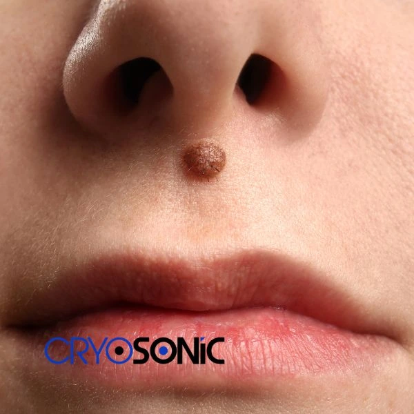 Start your benign moles removal treatment today Weston-Super-Mare