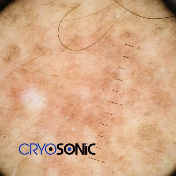 Speak to our team today about sun damaged skin treatment today in Weston-Super-Mare
