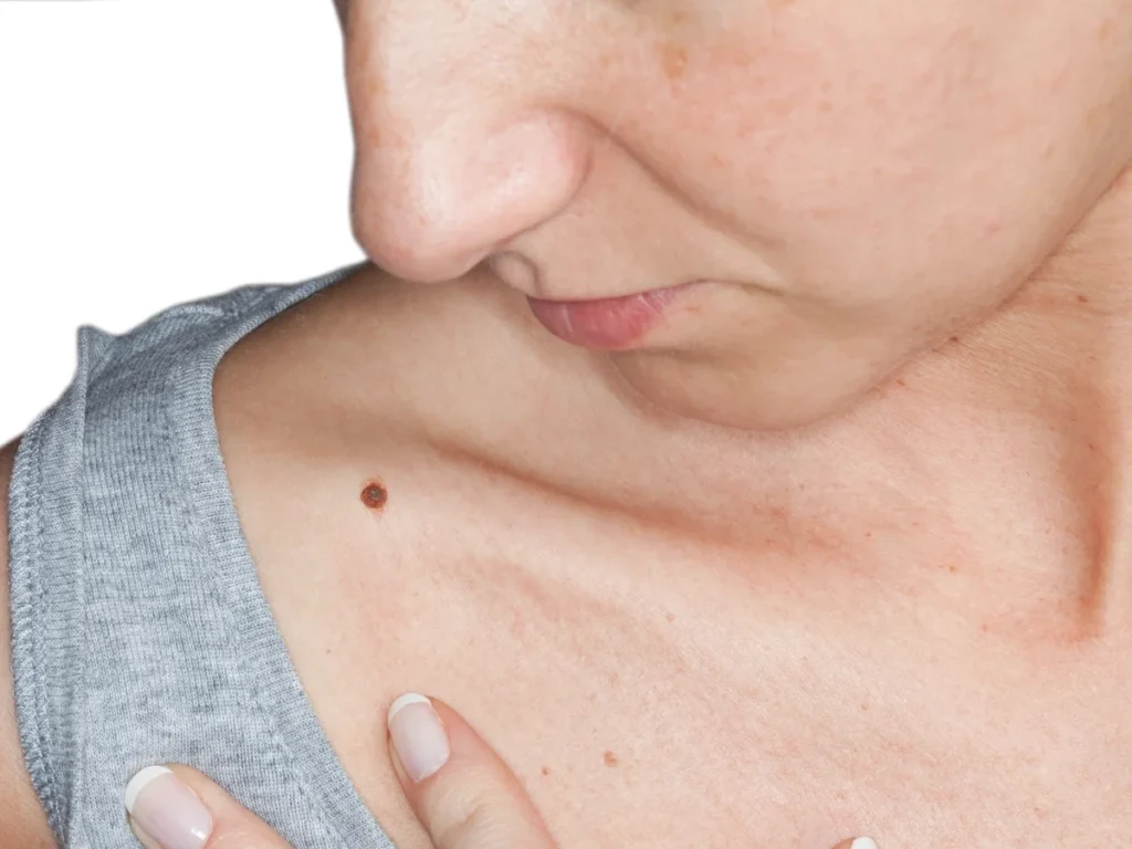 How Does CryoPen Sun Damage Treatment Weston-Super-Mare Work? Weston-Super-Mare