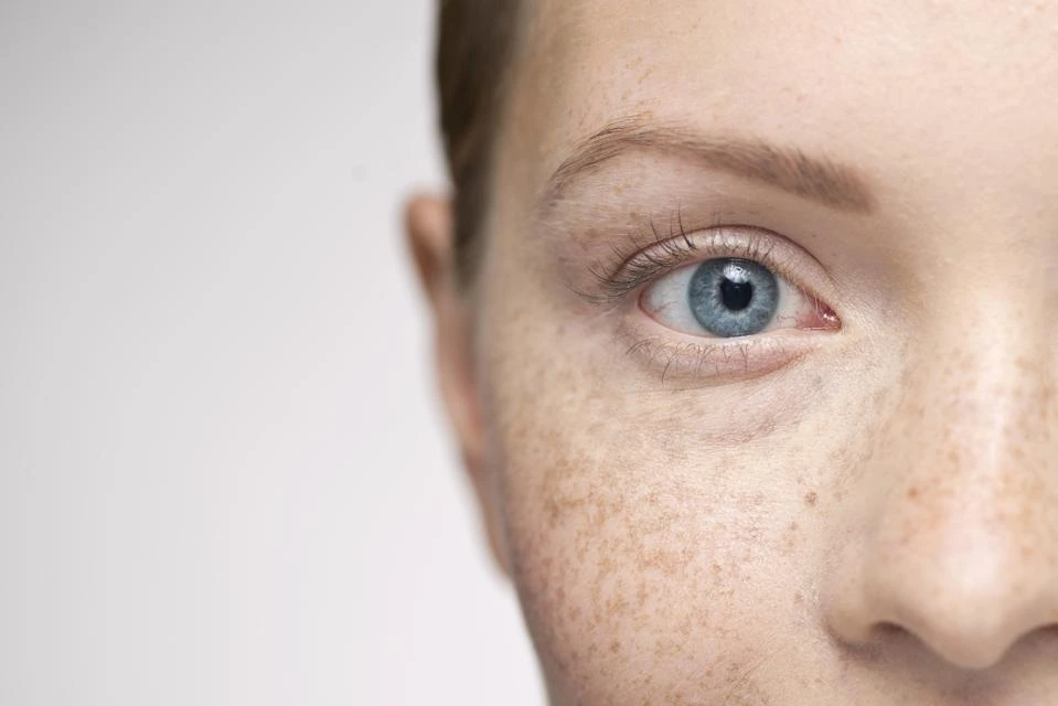 Understanding Sun Damage: How UV Rays Alter Skin and How CryoPen Can Reverse It Weston-Super-Mare