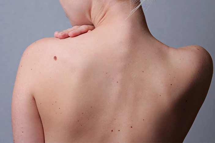 The Skin’s Healing Journey After CryoPen Sun Damage Treatment Weston-Super-Mare