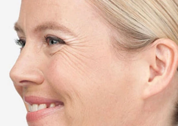 CryoPen Precision vs. Laser: Which Is Better for Sun-Damaged Skin? Weston-Super-Mare