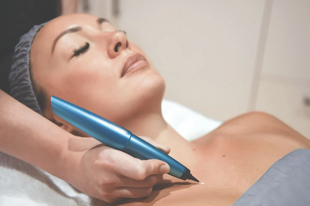 What is CryoPen Technology Weston-Super-Mare? Weston-Super-Mare