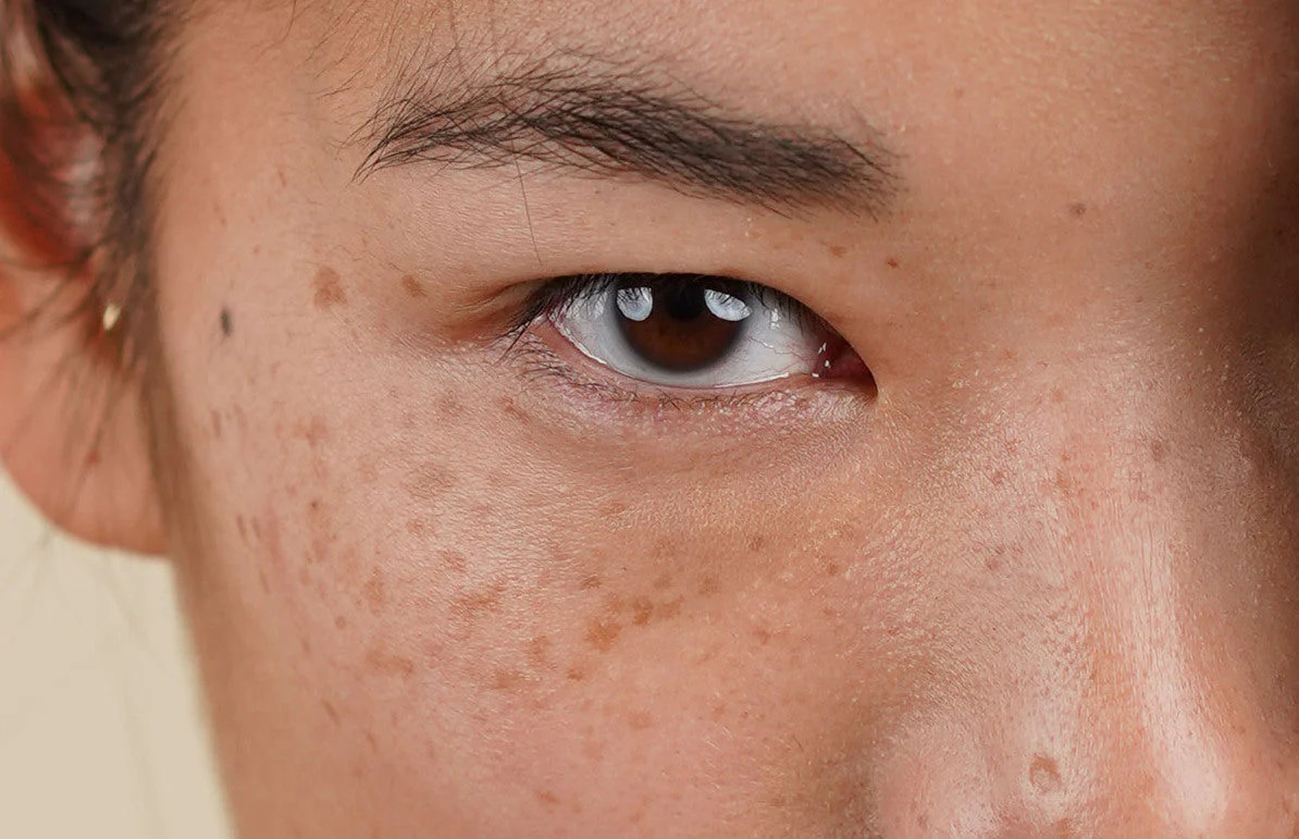 Is There Any Risk of Scarring or Pigmentation Weston-Super-Mare? Weston-Super-Mare