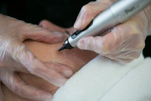 The CryoPen Technology Explained: How Extreme Cold Removes Sun-Damaged Skin Cells Weston-Super-Mare