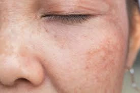 CryoPen Precision vs. Laser: Are Both Treatments Safe? Weston-Super-Mare