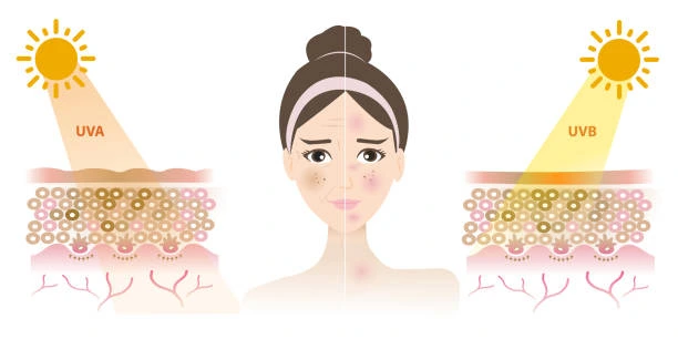 Understanding Sun Damage Weston-Super-Mare : How Do UV Rays Cause Changes in the Skin? Weston-Super-Mare