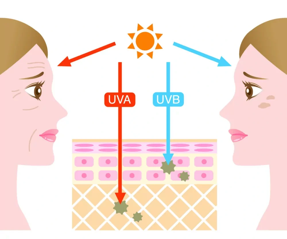 Understanding Sun Damage Weston-Super-Mare - Why Should Sun Damage Be Treated Early? Weston-Super-Mare
